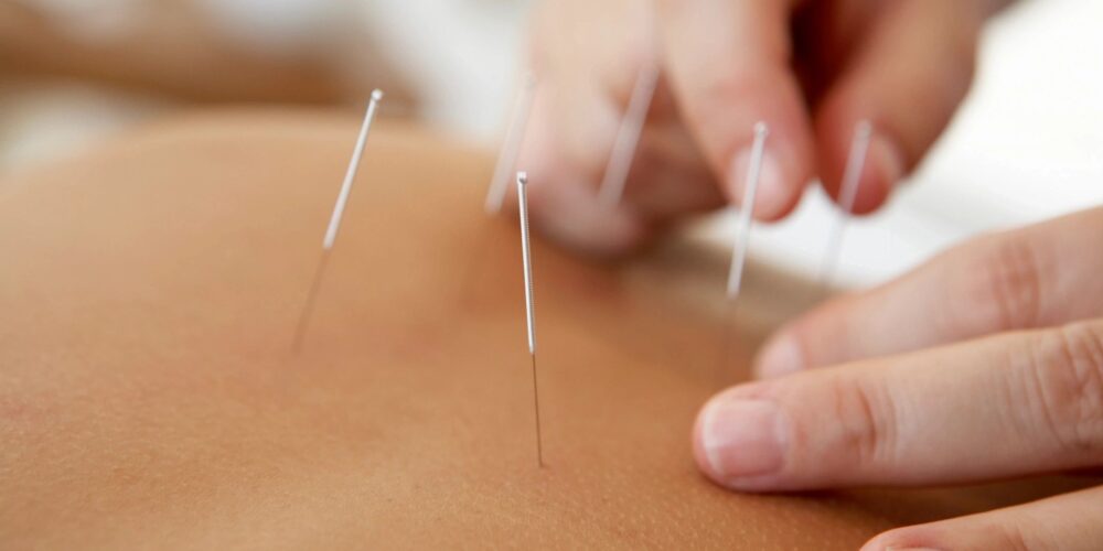 acupuncture needles being inserted and activated into a patient's skin for treatment